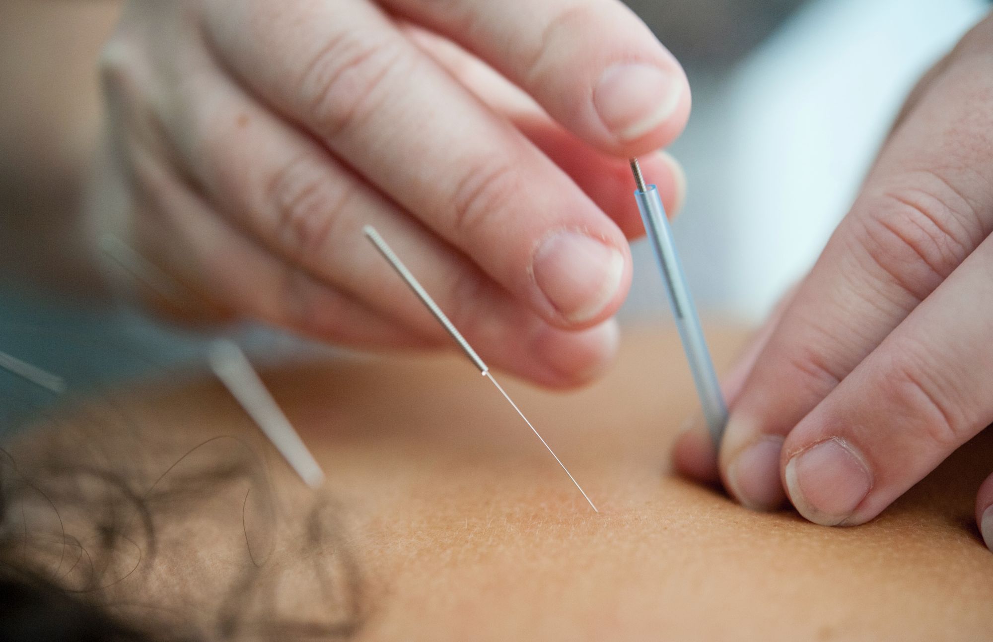 Tretman akupunkturom